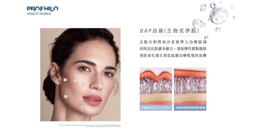 PROFHILO逆時針BAP生物美學技術