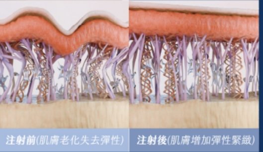 注射前-肌膚老化失去彈性-台中-緻己美學
